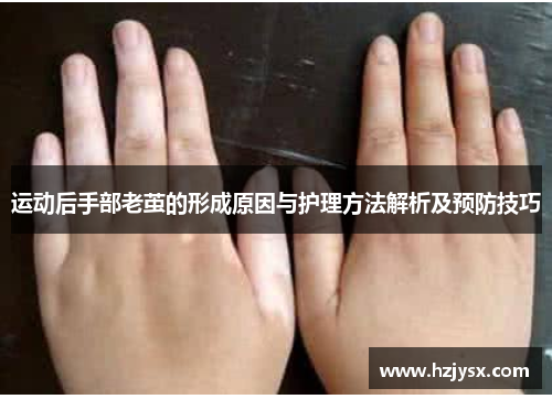 运动后手部老茧的形成原因与护理方法解析及预防技巧